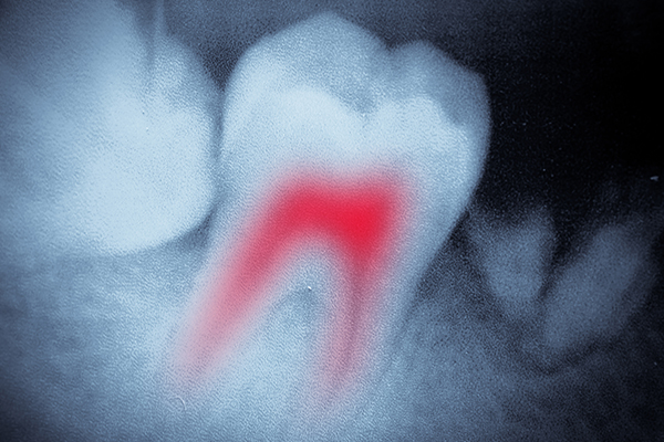 Afbeelding endodontologie